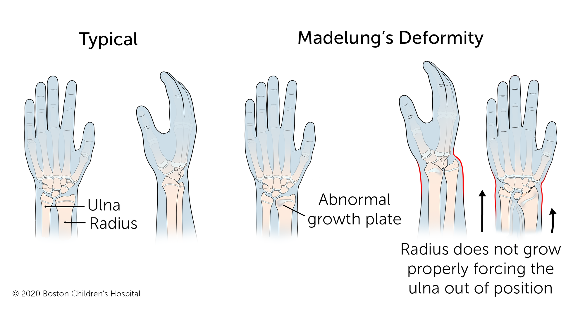 Madelungs Deformity Boston Childrens Hospital Ob欧宝体育app下载