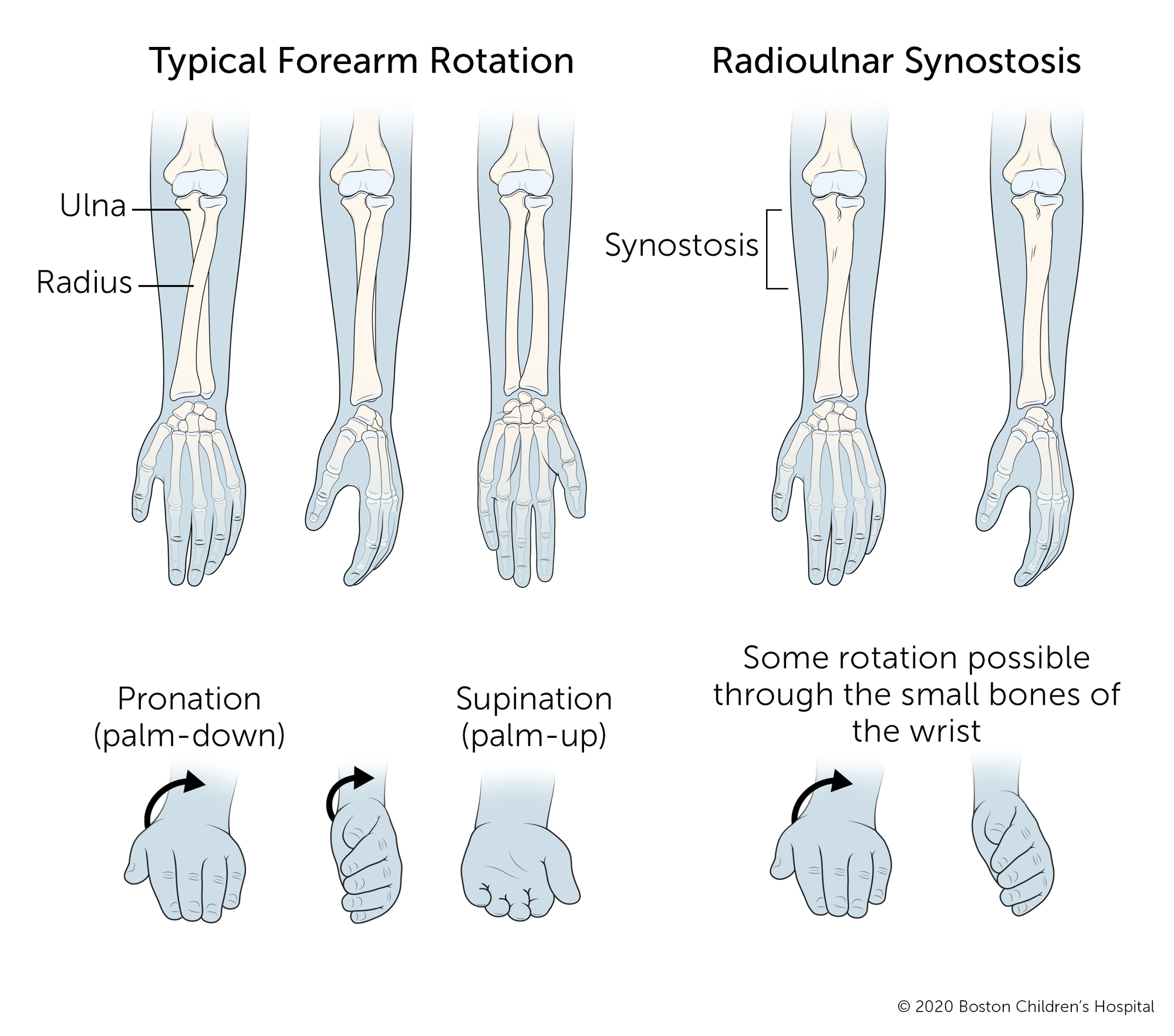 Radioulnar synostosis | Boston Children's Hospital - ob欧宝体育app下载